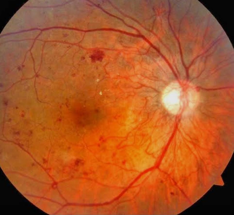 Glaucoma Treatment Pune